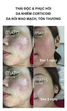 Thải độc da nhiễm cortiocid