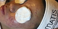 Trị mụn trứng cá
