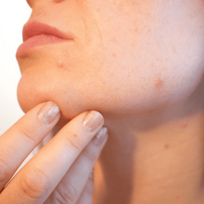 Loạn khuẩn trên da và xu hướng mới trong việc điều trị mụn trứng cá